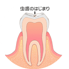 歯の表面の脱灰