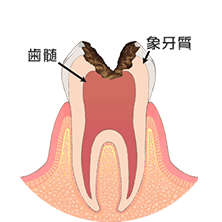 歯の神経まで達した虫歯