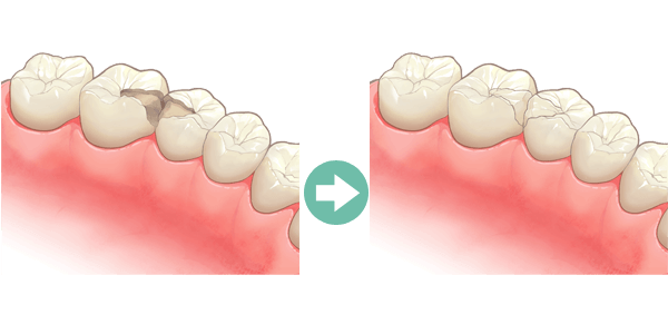 歯の中（象牙質）まで進んだ虫歯