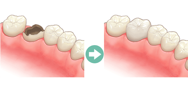 歯の神経まで達した虫歯