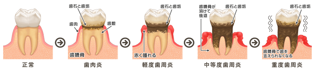 歯周病の進行